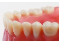 ساخت دست دندان - حذف جرم دندان