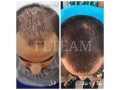 درمان تضمین شده جلوگیری از ریزش مو و رویش مجدد مو - خط رویش