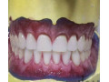 دندانسازی ارزان در تهرانسر - دندانسازی منطقه 4