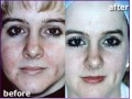 رفع کننده کلیه چین و چروک صورت-پوست،رفع کننده لک های پوستی و سفید کننده پوست - پوست کن پوست ران