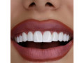 Icon for کامپوزیت و لمینت دندان در دندانپزشکی مهرنیکان کرج