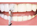 Icon for سفید کردن دندان ها