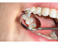 ترمیم پوسیدگی های دندانی - ضد پوسیدگی