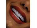 Icon for  کامپوزیت ونیر دندان- کامپوزیت لامینیت-خانم دکتر طاهره شاکری اصیل