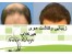 کاشت مو ,کاشت ابرو , hairklap