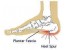درمان قطعی خار پاشنه (Heel Spur)