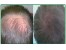 تزریق سلولهای بنیادی pRp